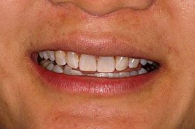 Amber-Lui-After_Whitening-375x230_280wx185h