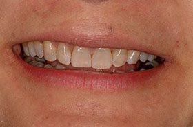 Amber-Lui-Before_Whitening-375x230_280wx185h