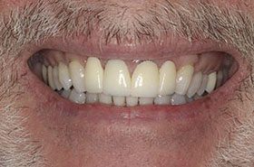 Ashton-After_Veneers-Crowns-375x230_280wx185h