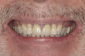 Ashton-Before_Veneers-Crowns-375x230_280wx185h