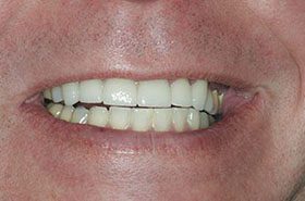 Barr-After_Veneers-Crowns-375x230_280wx185h