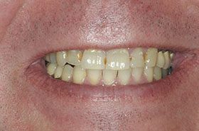 Barr-Before_Veneers-Crowns-375x230_280wx185h
