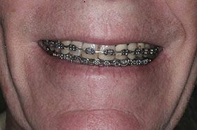 Barrett-Before_Veneers-Crowns-375x230_280wx185h