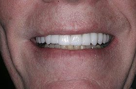 Barrett-Upper-Afters_Veneers-Crowns-375x230_280wx185h
