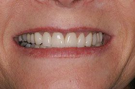 Bates-After-1_Veneers-Crowns-375x230_280wx185h