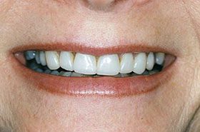 Bates-Before_Veneers-Crowns_upd-375x230_280wx185h