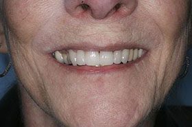 Bodenstadt-Marie-After_Veneers-Crowns-375x230_280wx185h