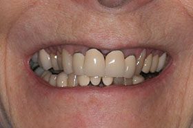 Bodenstadt-Marie-Before_Veneers-Crowns-375x230_280wx185h