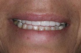 Boyd-Rhonda-After_Veneers-Crowns-375x230_280wx185h