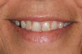 Boyd-Rhonda-Before_Veneers-Crowns-375x230_280wx185h