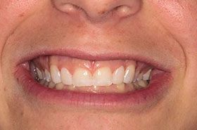 Burghoff-After_Bonding-375x230_280wx185h