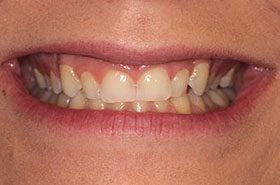 Burghoff-Before_Bonding-375x230_280wx185h