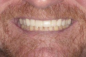 Clayton-John-After_Veneers-Crowns-375x230_280wx185h