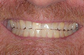 Clayton-John-Before_Veneers-Crowns-375x230_280wx185h
