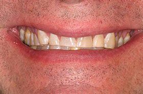Clevanna-After_Whitening-375x230_280wx185h