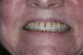 Clevanna-Before_Veneers-Crowns-375x230_280wx185h
