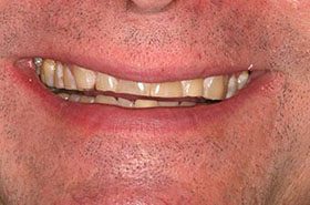Clevanna-Before_Whitening-375x230_280wx185h