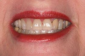 Cookie-After_Whitening-375x230_280wx185h