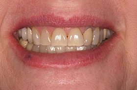 Cookie-Before_Whitening-375x230_280wx185h
