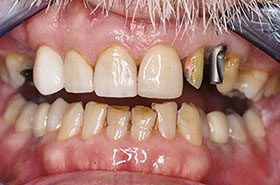 Cooksey-Before-2_Veneers-Crowns-375x230_280wx185h