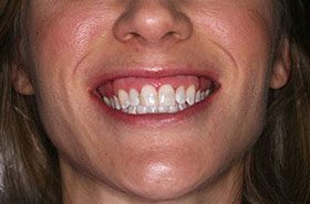 Cox-After_Whitening-375x230_280wx185h
