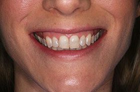 Cox-Before_Whitening-375x230_280wx185h