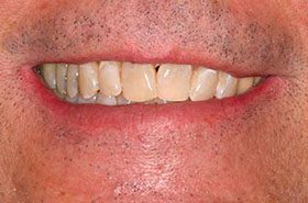 Cruz-After_Whitening-375x230_280wx185h