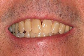 Cruz-Before_Whitening-375x230_280wx185h