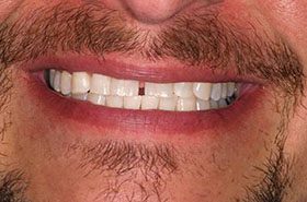 Dangler-After_Whitening-375x230_280wx185h