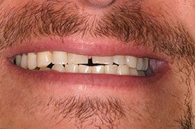 Dangler-Before_Whitening-375x230_280wx185h