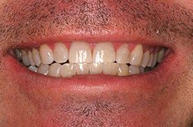 Eric-After_Whitening-375x230_280wx185h