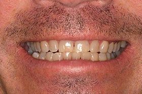 Eric-Before_Whitening-375x230_280wx185h