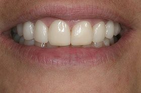 Ferguson-After-2_Veneers-Crowns-375x230_280wx185h