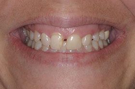 Ferguson-Before_Veneers-Crowns-375x230_280wx185h