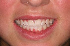 Fisher-After_Whitening-375x230_280wx185h