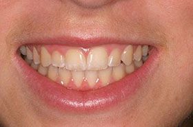 Fisher-Before_Whitening-375x230_280wx185h