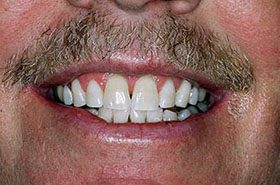 Fuller-After_Whitening-375x230_280wx185h