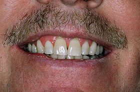 Fuller-Before_Whitening-375x230_280wx185h