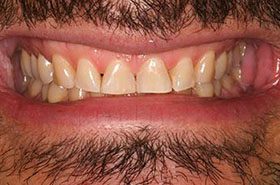 Furtado-After_Bonding-375x230_280wx185h
