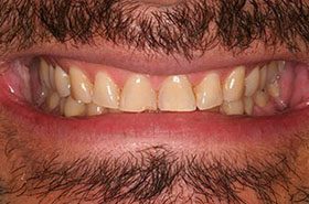 Furtado-Before_Bonding-375x230_280wx185h