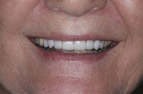 Gillis-After_Veneers-Crowns-375x230_280wx185h
