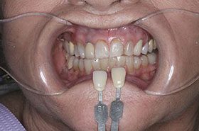 Gillis-Before_Veneers-Crowns-375x230_280wx185h