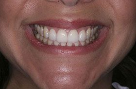 Gonzales-Maria-After_Veneers-Crowns-375x230_280wx185h