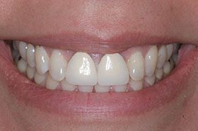 Gonzales-Maria-Before_Veneers-Crowns-375x230_280wx185h