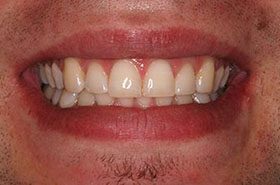 Hackman-After_Whitening-375x230_280wx185h