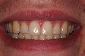 Hackman-Before_Whitening-375x230_280wx185h