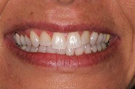 Harrison-After_Whitening-375x230_280wx185h