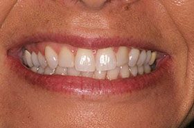 Harrison-Before_Whitening-375x230_280wx185h