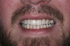 Hartness-After_Veneers-Crowns-375x230_280wx185h