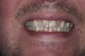 Hartness-Before_Veneers-Crowns-375x230_280wx185h